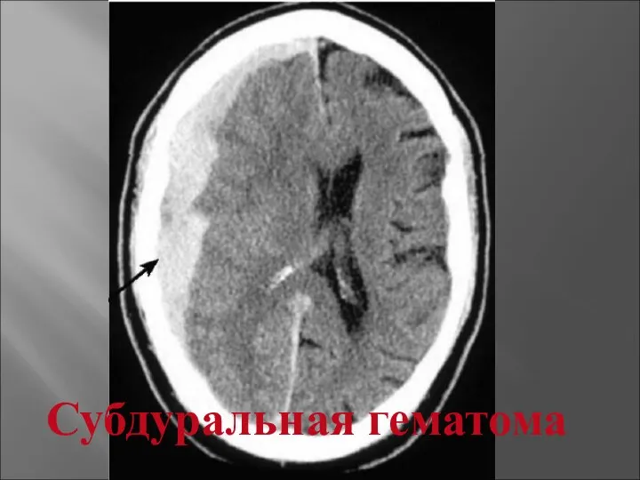 Субдуральная гематома