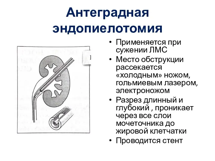 Антеградная эндопиелотомия Применяется при сужении ЛМС Место обструкции рассекается «холодным» ножом, гольмиевым