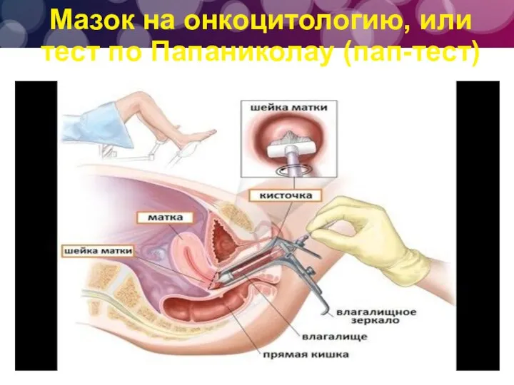 Мазок на онкоцитологию, или тест по Папаниколау (пап-тест)