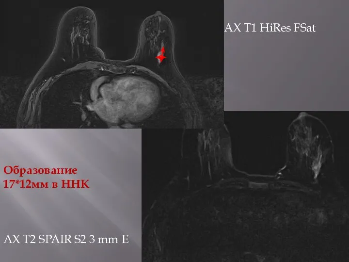 AX T1 HiRes FSat Образование 17*12мм в ННК AX T2 SPAIR S2 3 mm E