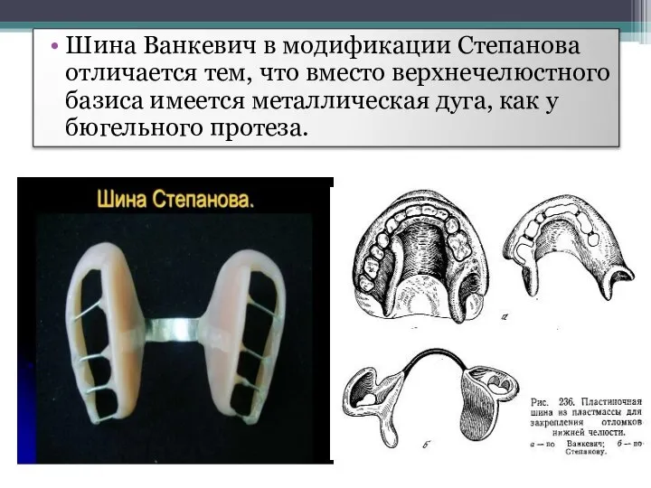 Шина Ванкевич в модификации Степанова отличается тем, что вместо верхнечелюстного базиса имеется