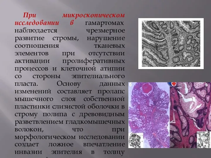 При микроскопическом исследовании в гамартомах наблюдается чрезмерное развитие стромы, нарушение соотношения тканевых