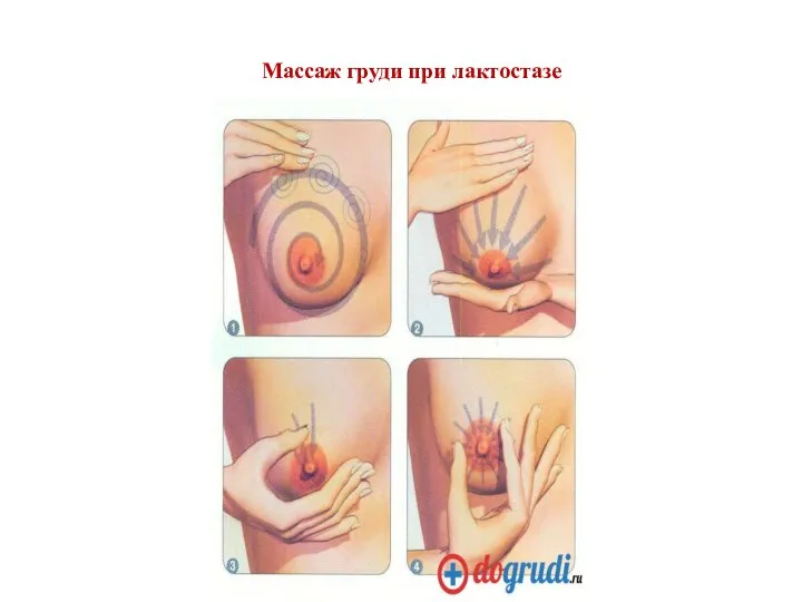 Массаж груди при лактостазе