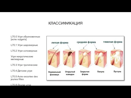 КЛАССИФИКАЦИЯ L70.0 Угри обыкновенные [acne vulgaris] L70.1 Угри шаровидные L70.2 Угри осповидные