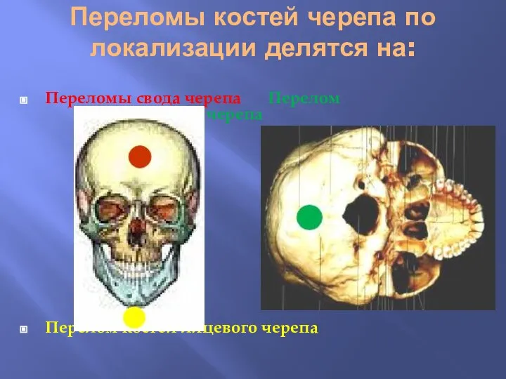 Переломы костей черепа по локализации делятся на: Переломы свода черепа Перелом основания