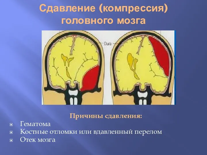 Сдавление (компрессия) головного мозга Причины сдавления: Гематома Костные отломки или вдавленный перелом Отек мозга