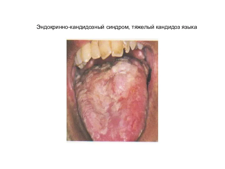 Эндокринно-кандидозный синдром, тяжелый кандидоз языка