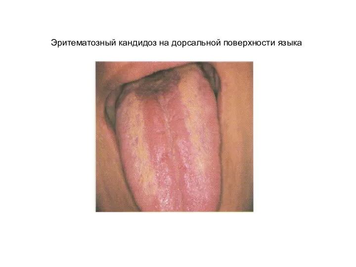 Эритематозный кандидоз на дорсальной поверхности языка