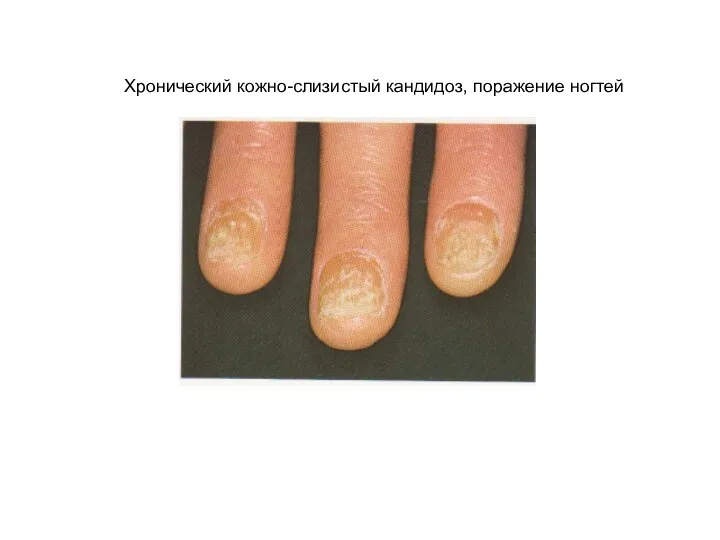 Хронический кожно-слизистый кандидоз, поражение ногтей