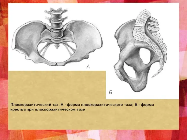 Плоскорахитический таз. А - форма плоскорахитического таза; Б - форма крестца при плоскорахитическом тазе А Б