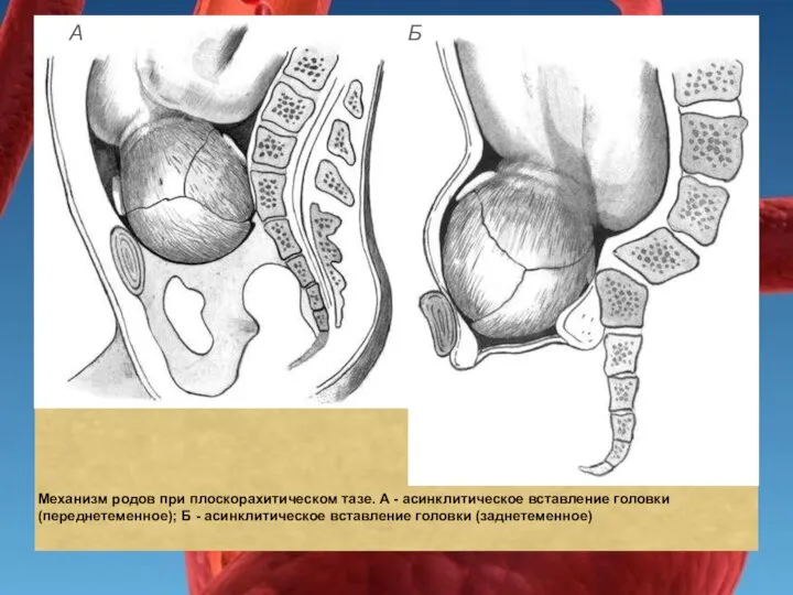 Механизм родов при плоскорахитическом тазе. А - асинклитическое вставление головки (переднетеменное); Б