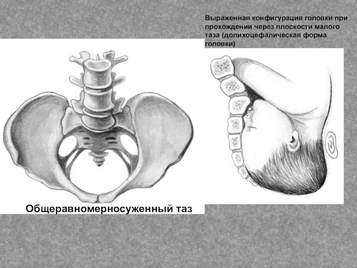 Выраженная конфигурация головки при прохождении через плоскости малого таза (долихоцефалическая форма головки) Общеравномерносуженный таз