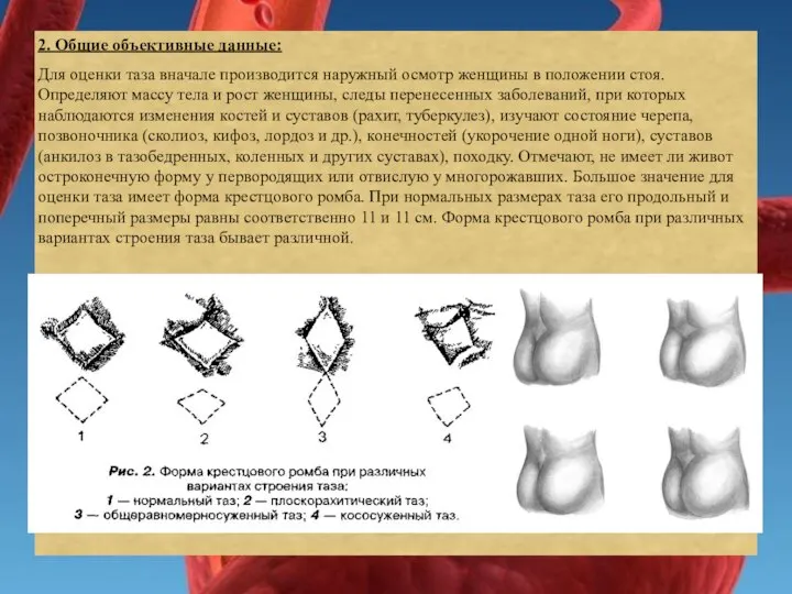 2. Общие объективные данные: Для оценки таза вначале производится наружный осмотр женщины