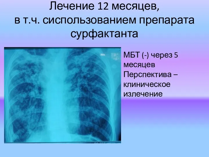 Лечение 12 месяцев, в т.ч. сиспользованием препарата сурфактанта МБТ (-) через 5