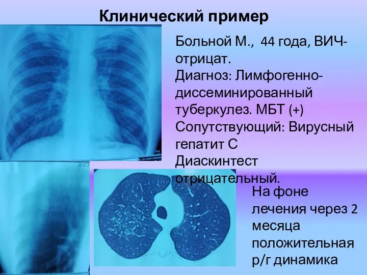 Клинический пример Больной М., 44 года, ВИЧ- отрицат. Диагноз: Лимфогенно-диссеминированный туберкулез. МБТ