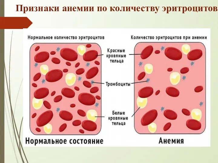 Признаки анемии по количеству эритроцитов