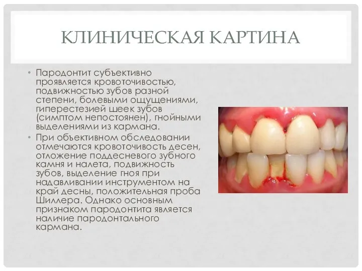 КЛИНИЧЕСКАЯ КАРТИНА Пародонтит субъективно проявляется кровоточивостью, подвижностью зубов разной степени, болевыми ощущениями,