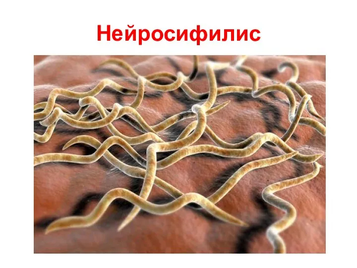 Нейросифилис