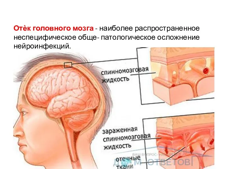 Отѐк головного мозга - наиболее распространенное неспецифическое обще- патологическое осложнение нейроинфекций.