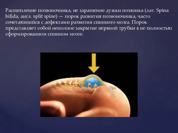 Расщепление позвоночника, не заращение дужки позвонка (лат. Spina bifida, англ. split spine)