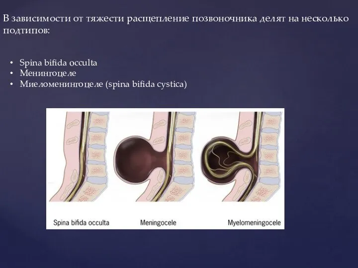 В зависимости от тяжести расщепление позвоночника делят на несколько подтипов: Spina bifida