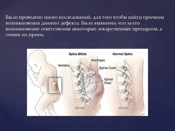 Было проведено много исследований, для того чтобы найти причины возникновения данного дефекта.