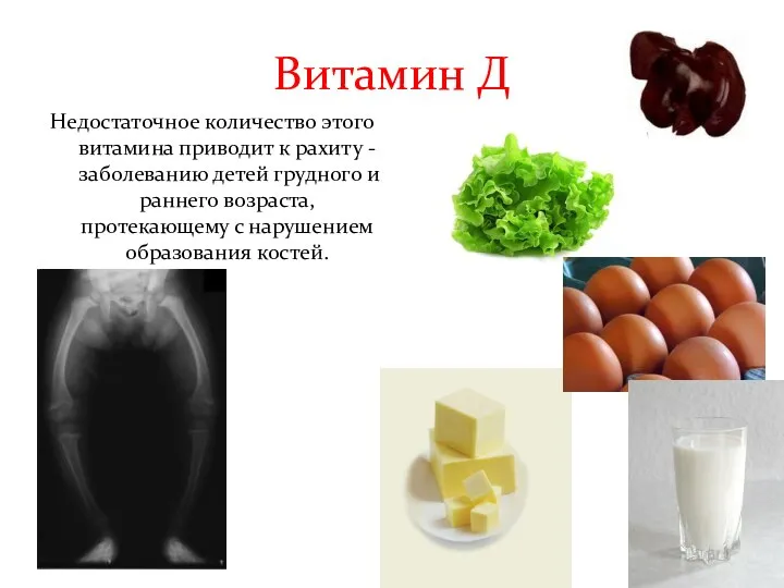 Витамин Д Недостаточное количество этого витамина приводит к рахиту - заболеванию детей