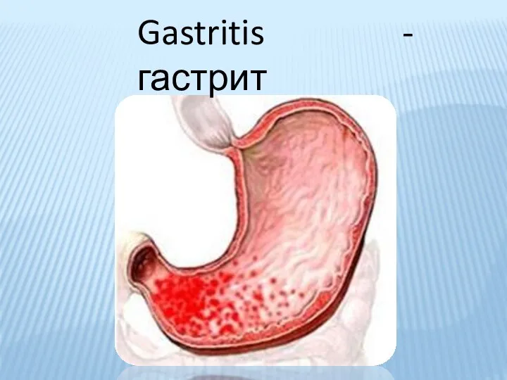 Gastritis - гастрит