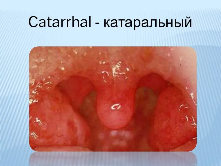 Catarrhal - катаральный