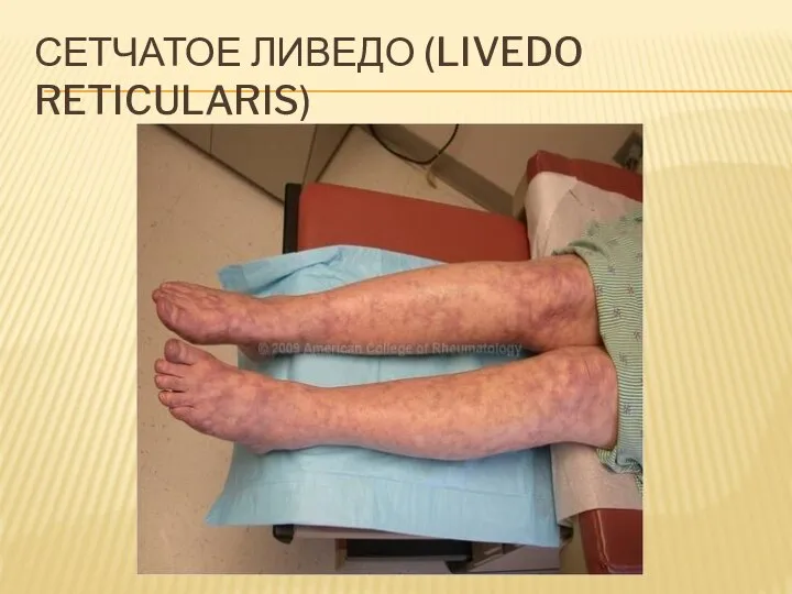 СЕТЧАТОЕ ЛИВЕДО (LIVEDO RETICULARIS)