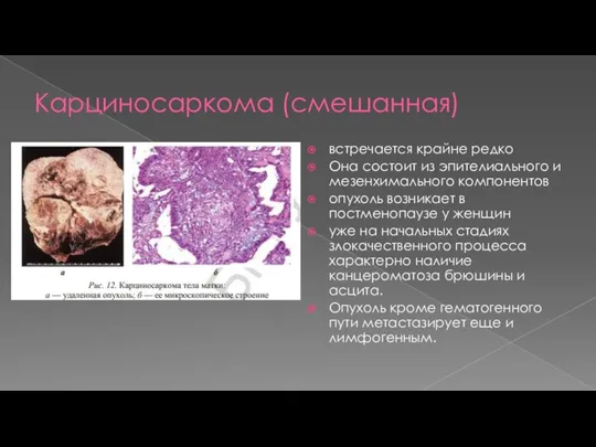 Карциносаркома (смешанная) встречается крайне редко Она состоит из эпителиального и мезенхимального компонентов