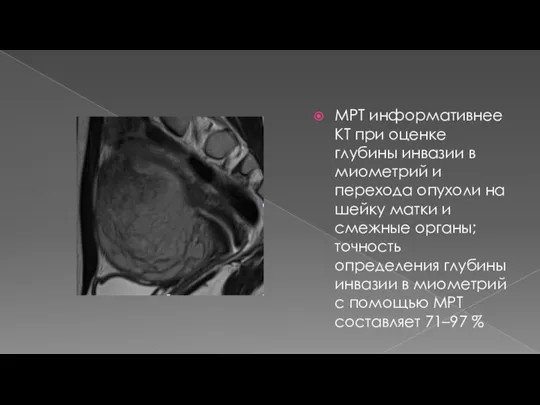 МРТ информативнее КТ при оценке глубины инвазии в миометрий и перехода опухоли