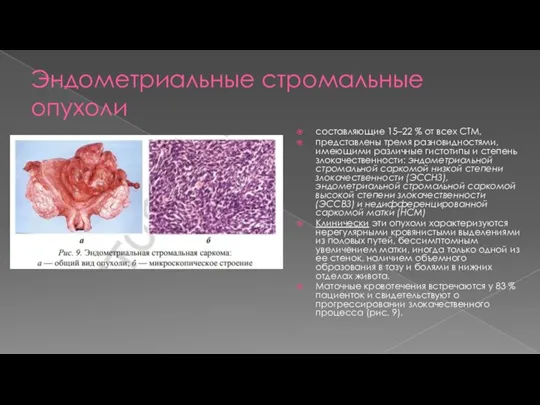 Эндометриальные стромальные опухоли составляющие 15–22 % от всех СТМ, представлены тремя разновидностями,