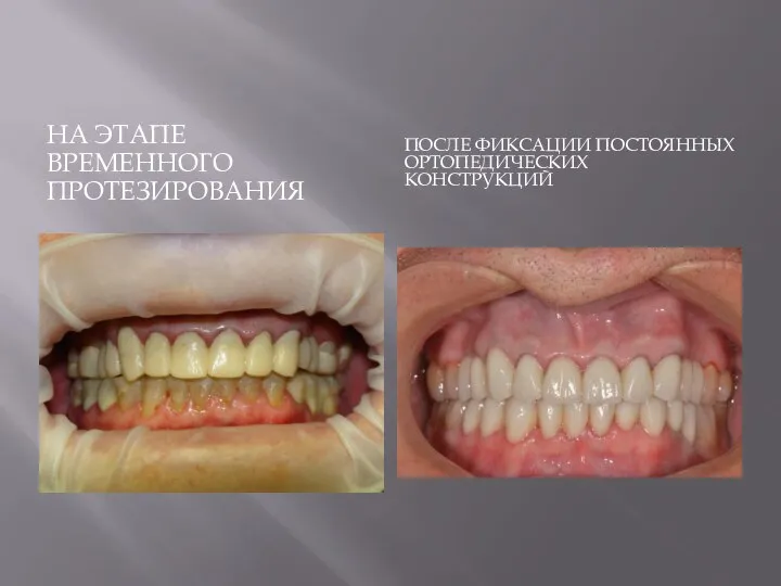 НА ЭТАПЕ ВРЕМЕННОГО ПРОТЕЗИРОВАНИЯ ПОСЛЕ ФИКСАЦИИ ПОСТОЯННЫХ ОРТОПЕДИЧЕСКИХ КОНСТРУКЦИЙ