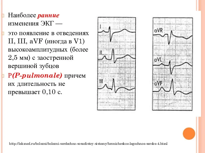 Наиболее ранние изменения ЭКГ — это появление в отведениях II, III, aVF