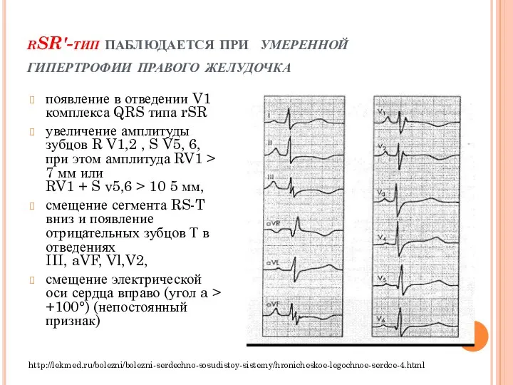 rSR'-тип паблюдается при умеренной гипертрофии правого желудочка появление в отведении V1 комплекса