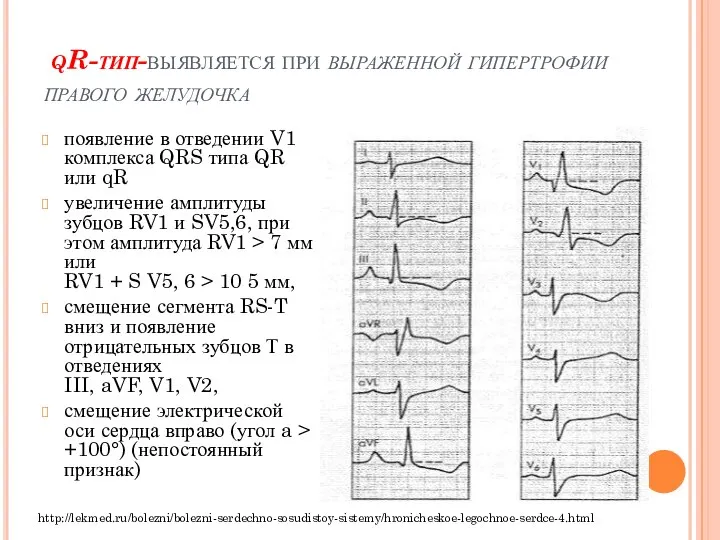 qR-тип-выявляется при выраженной гипертрофии правого желудочка появление в отведении V1 комплекса QRS