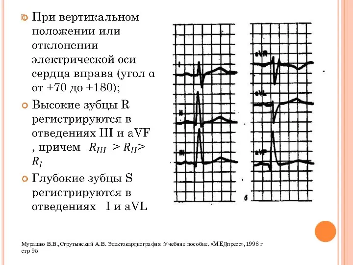 Мурашко В.В.,Струтынский А.В. Электокардиография :Учебние пособие. «MEДпресс»,1998 г стр 95