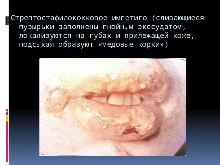 Стрептостафилококковое импетиго (сливающиеся пузырьки заполнены гнойным экссудатом, локализуются на губах и прилежащей