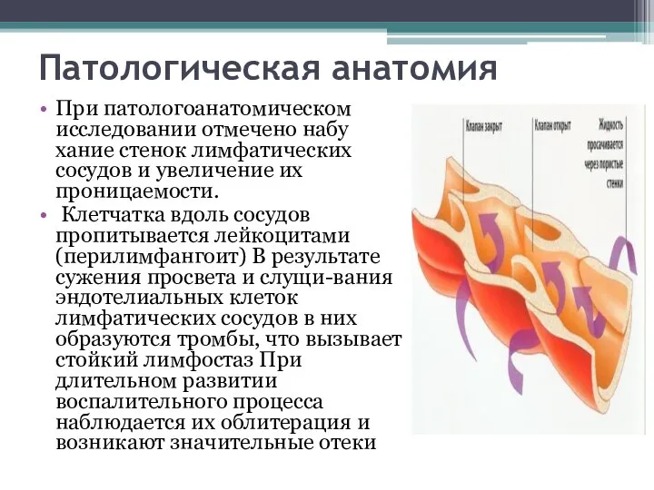 Патологическая анатомия При патологоанатомическом исследовании отмечено набу­хание стенок лимфатических сосудов и увеличение