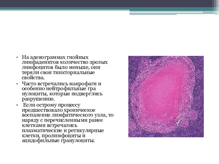 На аденограммах гнойных лимфаденитов количество зрелых лимфоцитов было меньше, они теряли свои