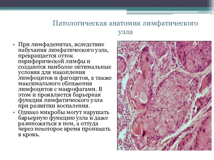 При лимфаденитах, вследствие набухания лимфатического узла, прекращается отток периферической лимфы и создаются
