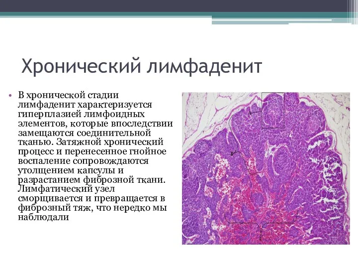 Хронический лимфаденит В хронической стадии лимфаденит характеризуется гиперплазией лимфоидных элемен­тов, которые впоследствии