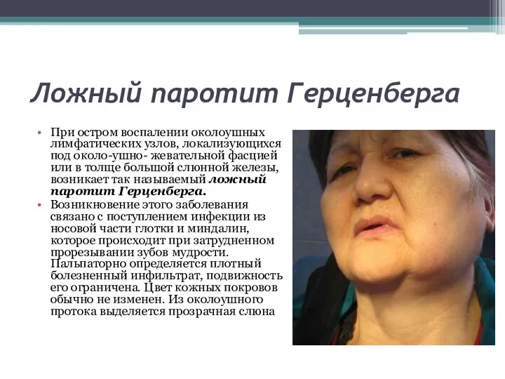 Ложный паротит Герценберга При остром воспалении околоушных лимфатических узлов, локализующихся под около-ушно-