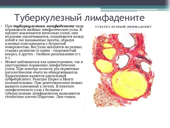 Туберкулезный лимфадените При туберкулезном лимфадените чаще поражаются шейные лимфатические узлы. В процесс