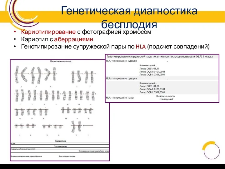 Генетическая диагностика бесплодия Кариотипирование с фотографией хромосом Кариотип с аберрациями Генотипирование супружеской