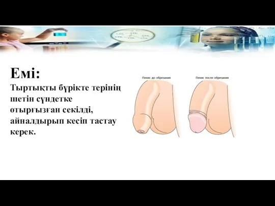 Емі: Тыртықты бүрікте терінің шетін сүндетке отырғызған секілді, айналдырып кесіп тастау керек.