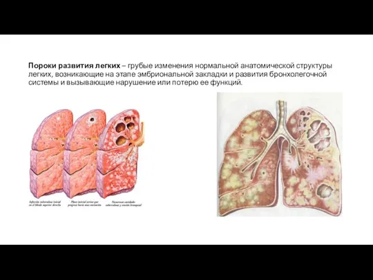 Пороки развития легких – грубые изменения нормальной анатомической структуры легких, возникающие на