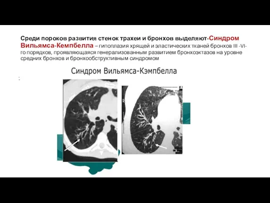 Среди пороков развития стенок трахеи и бронхов выделяют-Синдром Вильямса-Кемпбелла – гипоплазия хрящей