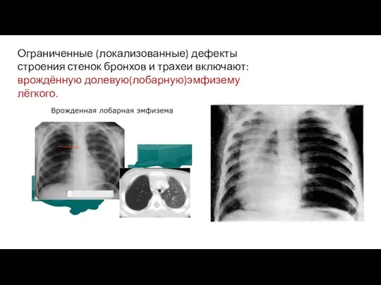 Ограниченные (локализованные) дефекты строения стенок бронхов и трахеи включают:врождённую долевую(лобарную)эмфизему лёгкого.